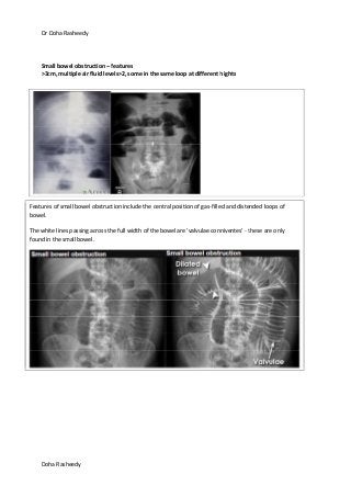 Dr Doha Rasheedy
Doha Rasheedy
Small bowel obstruction – features
>3cm, multiple air fluid levels>2, some in the same loop at different hights
Features of small bowel obstruction include the central position of gas-filled and distended loops of
bowel.
The white lines passing across the full width of the bowel are 'valvulae conniventes' - these are only
found in the small bowel.
 
