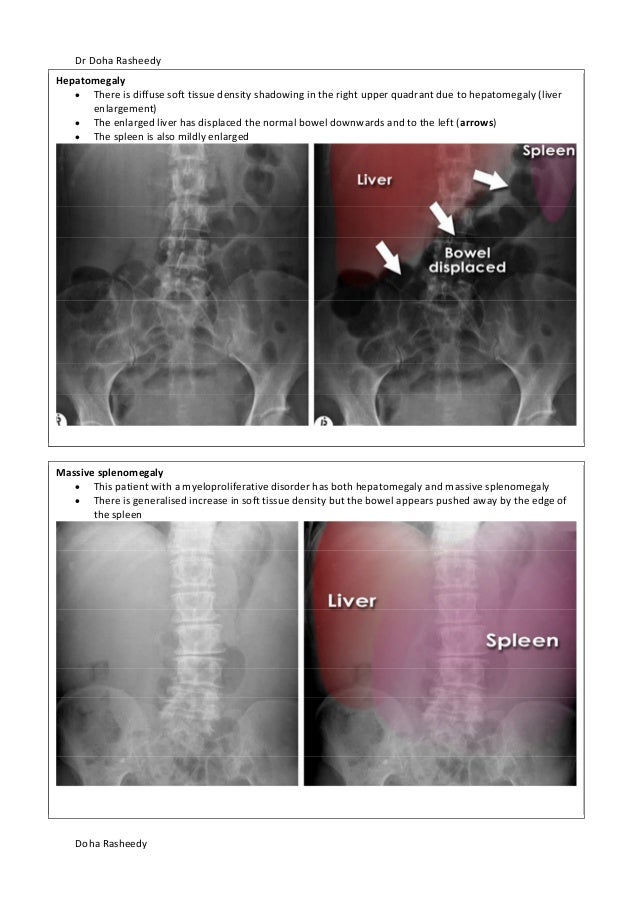 X Ray Abdomen X Ray Abdomen