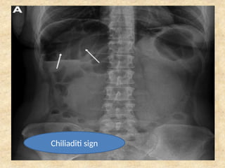 X ray Abdomen, x ray supine and erect .pptx