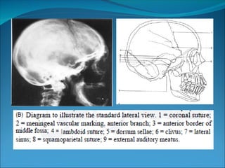 X RAY ANATOMY OF NORMAL SKULL.ppt heiejehehueh | PPT