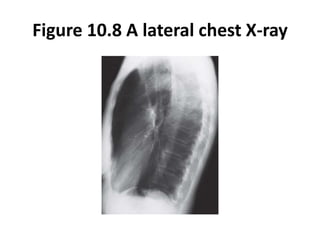 Figure 10.8 A lateral chest X-ray
 