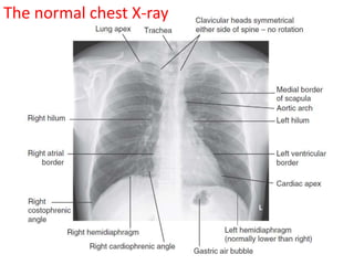 The normal chest X-ray
 