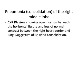 Pneumonia (consolidation) of the right
middle lobe
• CXR PA view showing opacification beneath
the horizontal fissure and loss of normal
contrast between the right heart border and
lung. Suggestive of Rt sided consolidation.
 