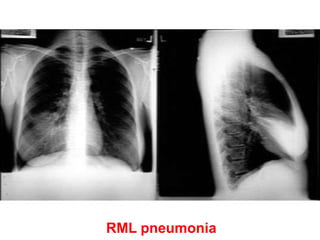 RML pneumonia
 
