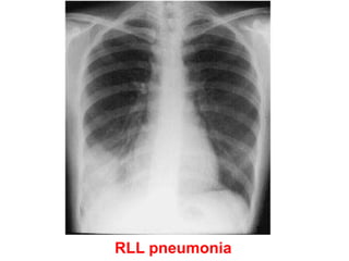 RLL pneumonia
 