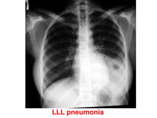LLL pneumonia
 