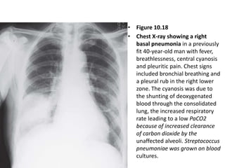 • Figure 10.18
• Chest X-ray showing a right
basal pneumonia in a previously
fit 40-year-old man with fever,
breathlessness, central cyanosis
and pleuritic pain. Chest signs
included bronchial breathing and
a pleural rub in the right lower
zone. The cyanosis was due to
the shunting of deoxygenated
blood through the consolidated
lung, the increased respiratory
rate leading to a low PaCO2
because of increased clearance
of carbon dioxide by the
unaffected alveoli. Streptococcus
pneumoniae was grown on blood
cultures.
 