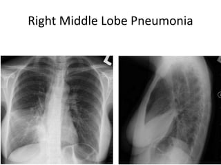 25
154 slides
Right Middle Lobe Pneumonia
25
 