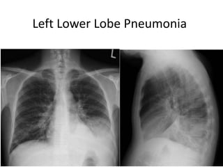 26
154 slides
Left Lower Lobe Pneumonia
26
 
