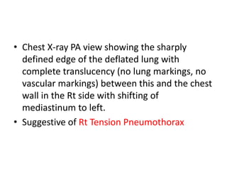 • Chest X-ray PA view showing the sharply
defined edge of the deflated lung with
complete translucency (no lung markings, no
vascular markings) between this and the chest
wall in the Rt side with shifting of
mediastinum to left.
• Suggestive of Rt Tension Pneumothorax
 
