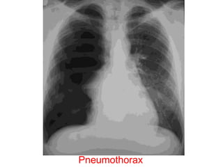 Pneumothorax
 