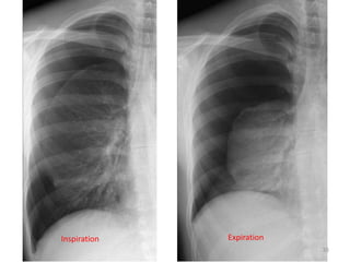 35
154 slides
Inspiration Expiration
35
 