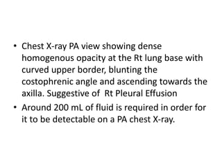 • Chest X-ray PA view showing dense
homogenous opacity at the Rt lung base with
curved upper border, blunting the
costophrenic angle and ascending towards the
axilla. Suggestive of Rt Pleural Effusion
• Around 200 mL of fluid is required in order for
it to be detectable on a PA chest X-ray.
 