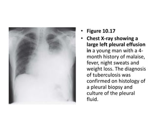 • Figure 10.17
• Chest X-ray showing a
large left pleural effusion
in a young man with a 4-
month history of malaise,
fever, night sweats and
weight loss. The diagnosis
of tuberculosis was
confirmed on histology of
a pleural biopsy and
culture of the pleural
fluid.
 
