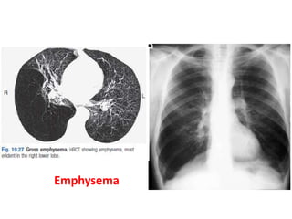 Emphysema
 