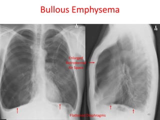 46
154 slides
Enlarged
Retrosternal
Air Space
Flattened Diaphragms
Bullous Emphysema
46
 