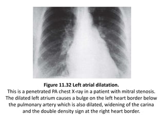 Figure 11.32 Left atrial dilatation.
This is a penetrated PA chest X-ray in a patient with mitral stenosis.
The dilated left atrium causes a bulge on the left heart border below
the pulmonary artery which is also dilated, widening of the carina
and the double density sign at the right heart border.
 