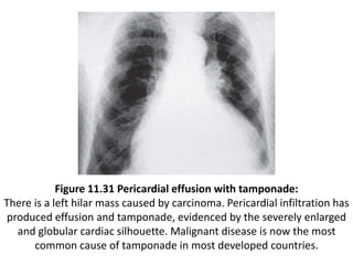 Figure 11.31 Pericardial effusion with tamponade:
There is a left hilar mass caused by carcinoma. Pericardial infiltration has
produced effusion and tamponade, evidenced by the severely enlarged
and globular cardiac silhouette. Malignant disease is now the most
common cause of tamponade in most developed countries.
 