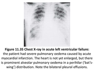Figure 11.35 Chest X-ray in acute left ventricular failure:
the patient had severe pulmonary oedema caused by acute
myocardial infarction. The heart is not yet enlarged, but there
is prominent alveolar pulmonary oedema in a perihilar (‘bat’s-
wing’) distribution. Note the bilateral pleural effusions.
 