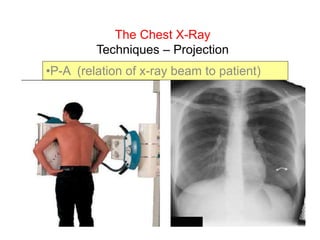 The Chest X-Ray
Techniques – Projection
•P-A (relation of x-ray beam to patient)
 