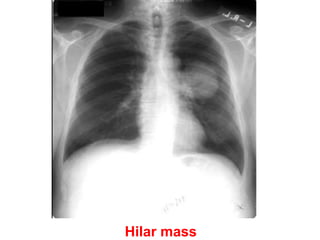 Hilar mass
 