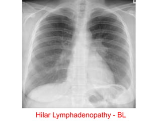 Hilar Lymphadenopathy - BL
 