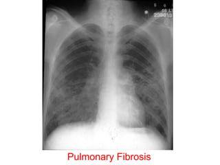 Pulmonary Fibrosis
 