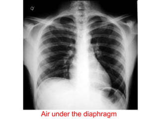 Air under the diaphragm
 