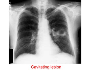 Cavitating lesion
 
