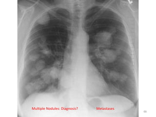 68
154 slides
Multiple Nodules: Diagnosis? Metastases
68
 
