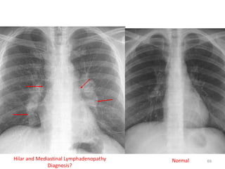 69
154 slides Normal
Hilar and Mediastinal Lymphadenopathy
Diagnosis?
69
 