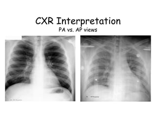 CXR Interpretation
PA vs. AP views
 