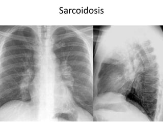 71
154 slides
Sarcoidosis
71
 