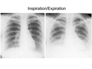 Inspiration/Expiration
 