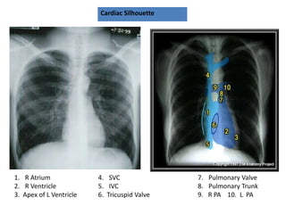 Cardiac Silhouette
1. R Atrium
2. R Ventricle
3. Apex of L Ventricle
4. SVC
5. IVC
6. Tricuspid Valve
7. Pulmonary Valve
8. Pulmonary Trunk
9. R PA 10. L PA
 