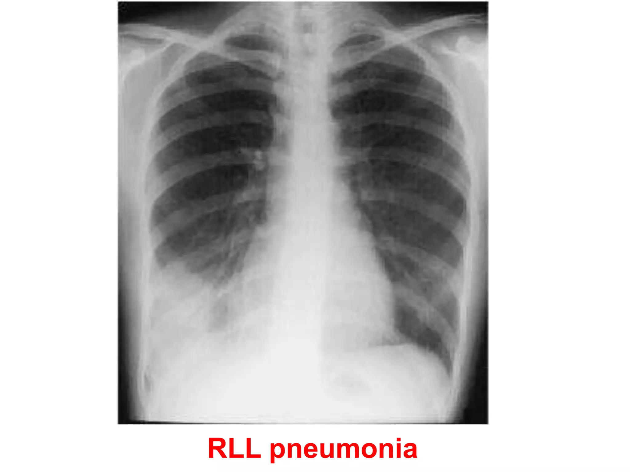 RLL pneumonia
 