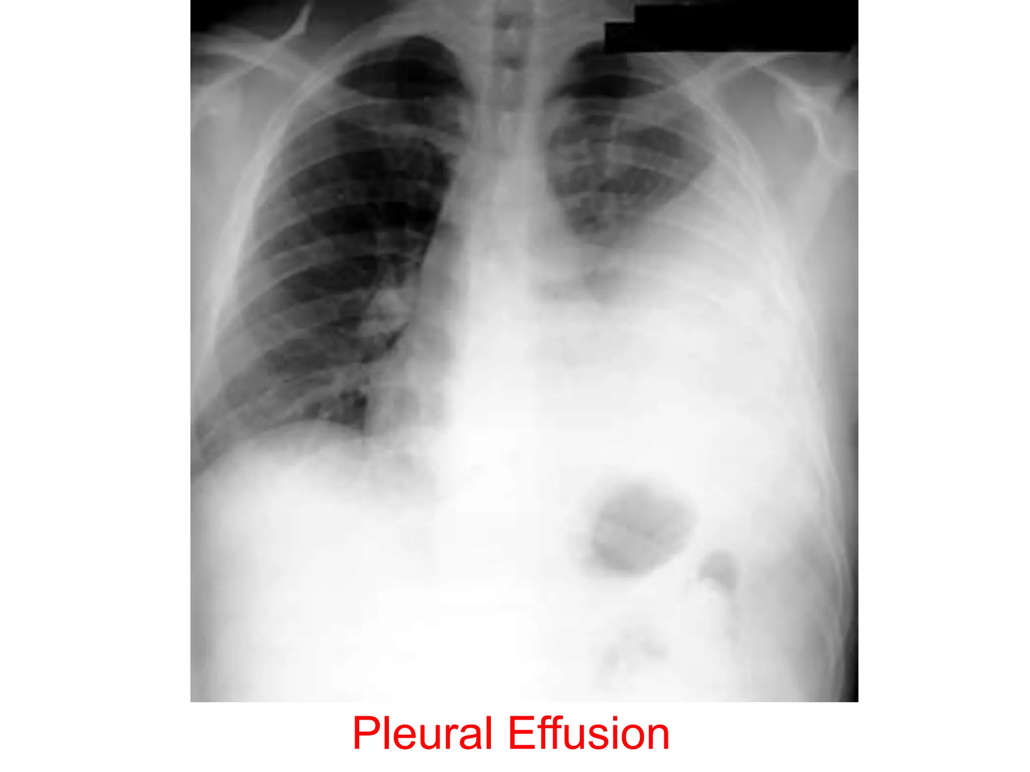 Pleural Effusion
 