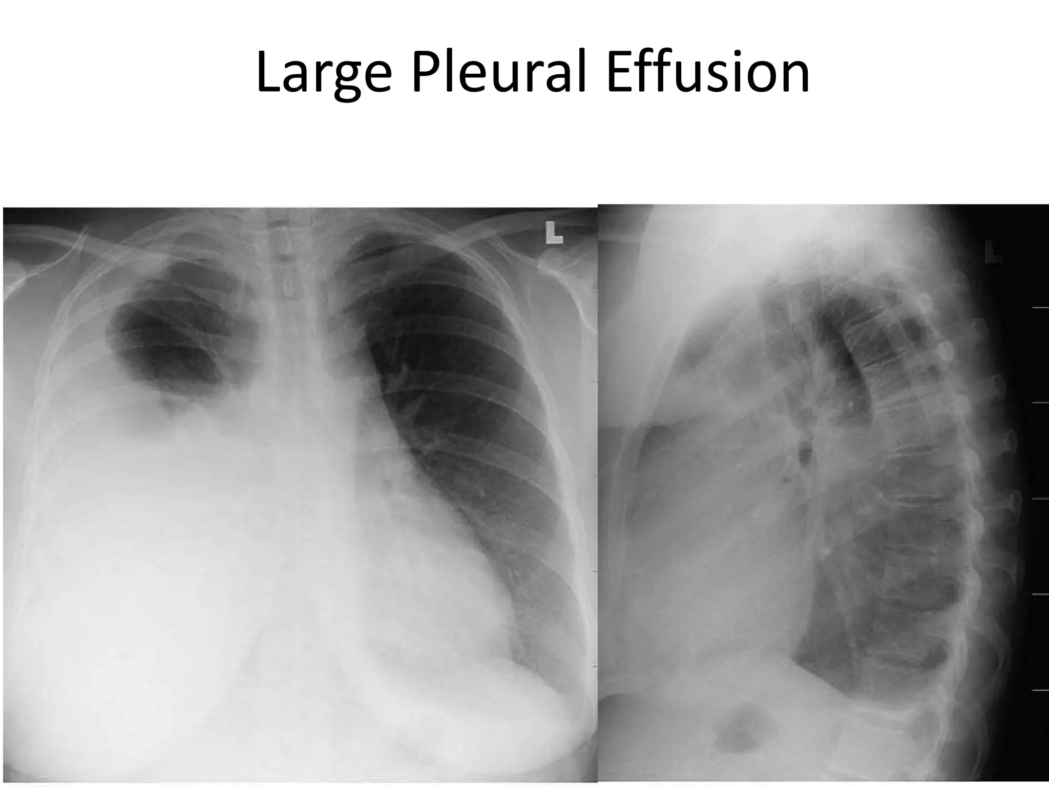 42154 slides
Large Pleural Effusion
42
 