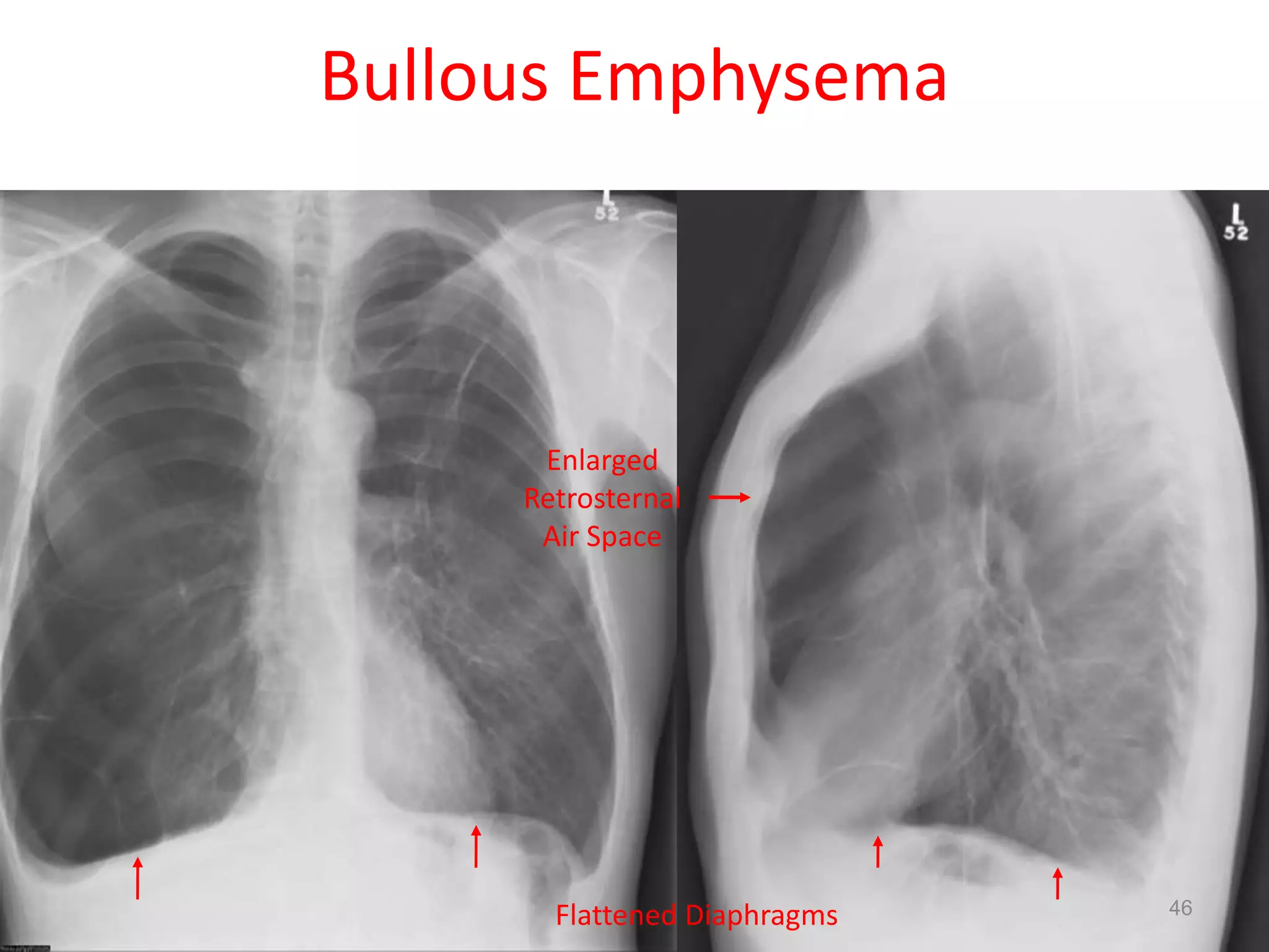 46154 slides
Enlarged
Retrosternal
Air Space
Flattened Diaphragms
Bullous Emphysema
46
 