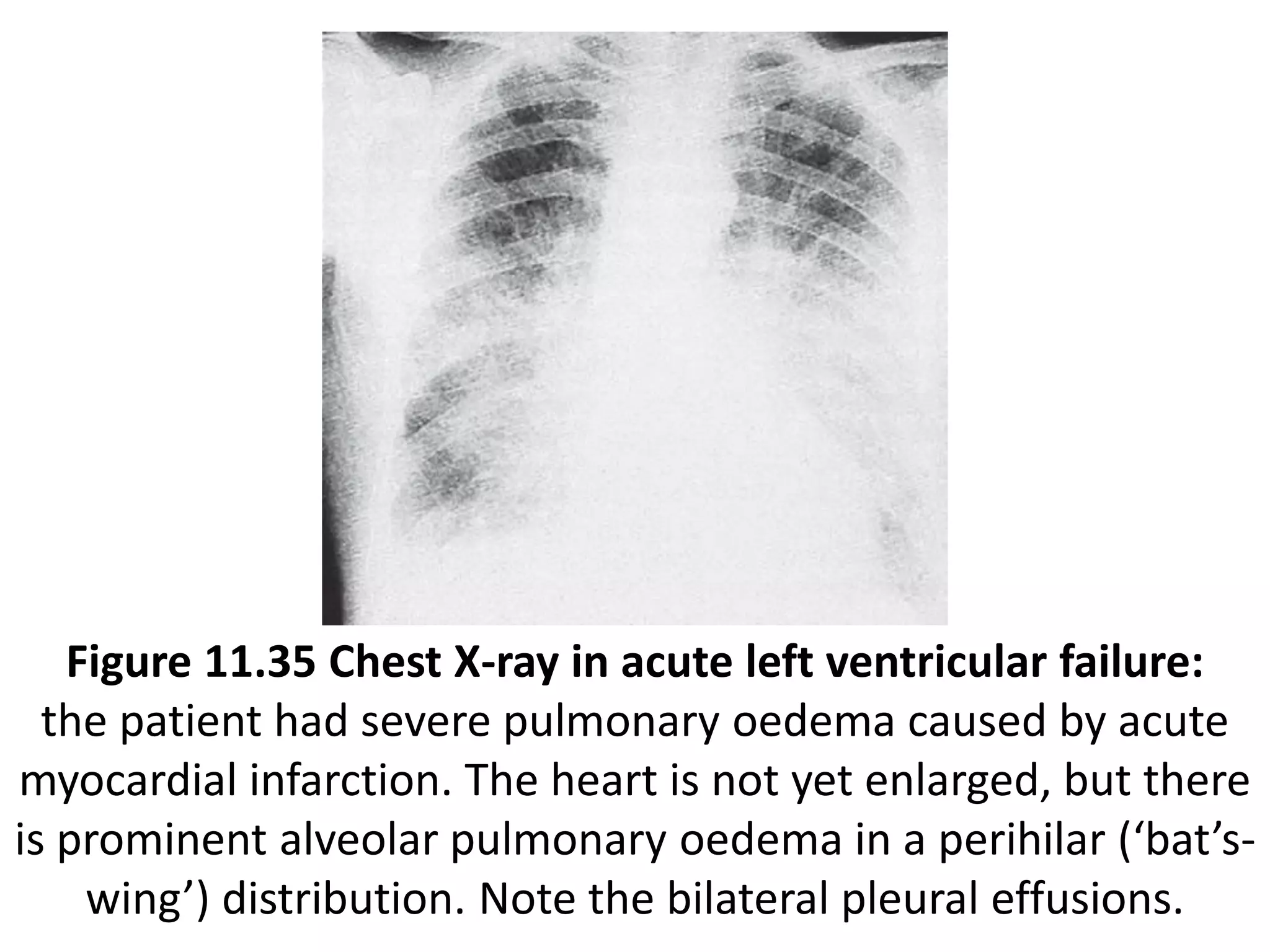 Figure 11.35 Chest X-ray in acute left ventricular failure:
the patient had severe pulmonary oedema caused by acute
myocardial infarction. The heart is not yet enlarged, but there
is prominent alveolar pulmonary oedema in a perihilar (‘bat’s-
wing’) distribution. Note the bilateral pleural effusions.
 
