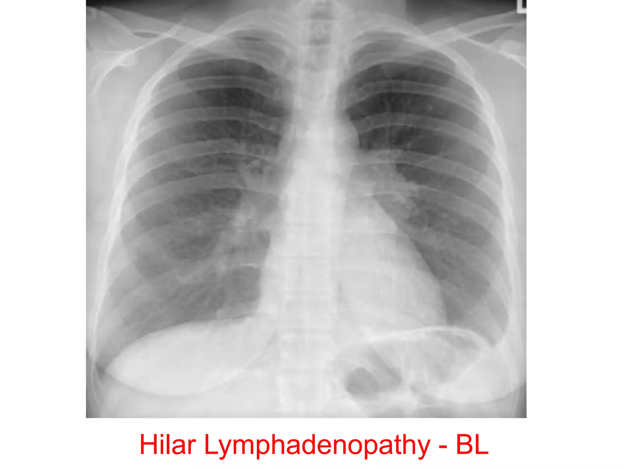 Hilar Lymphadenopathy - BL
 