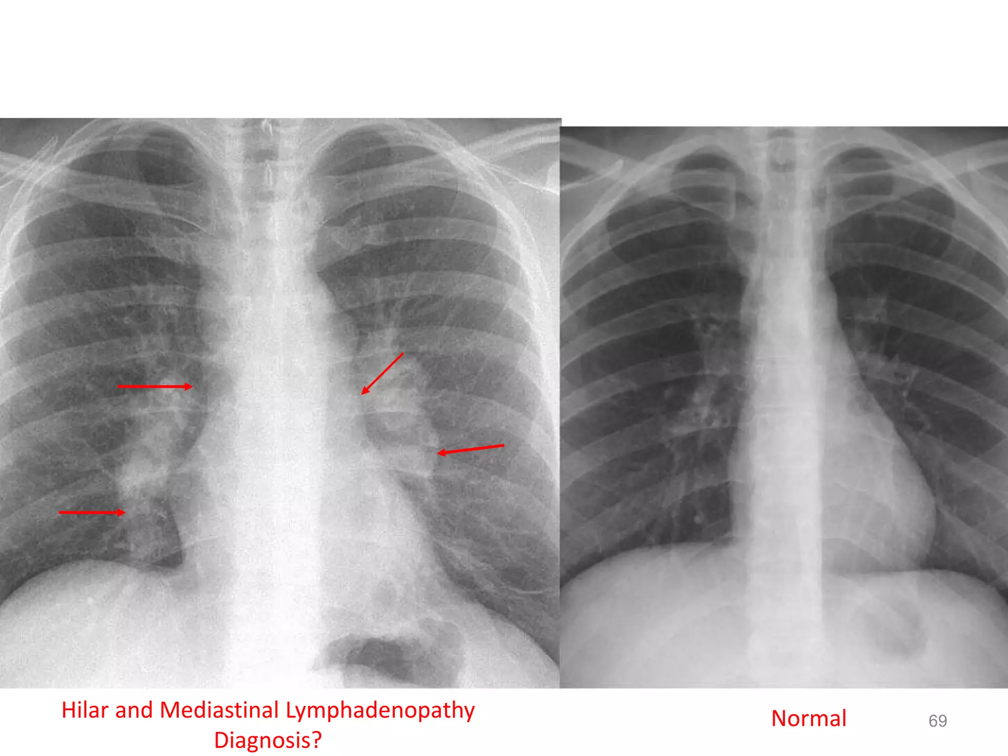 69154 slides NormalHilar and Mediastinal Lymphadenopathy
Diagnosis?
69
 