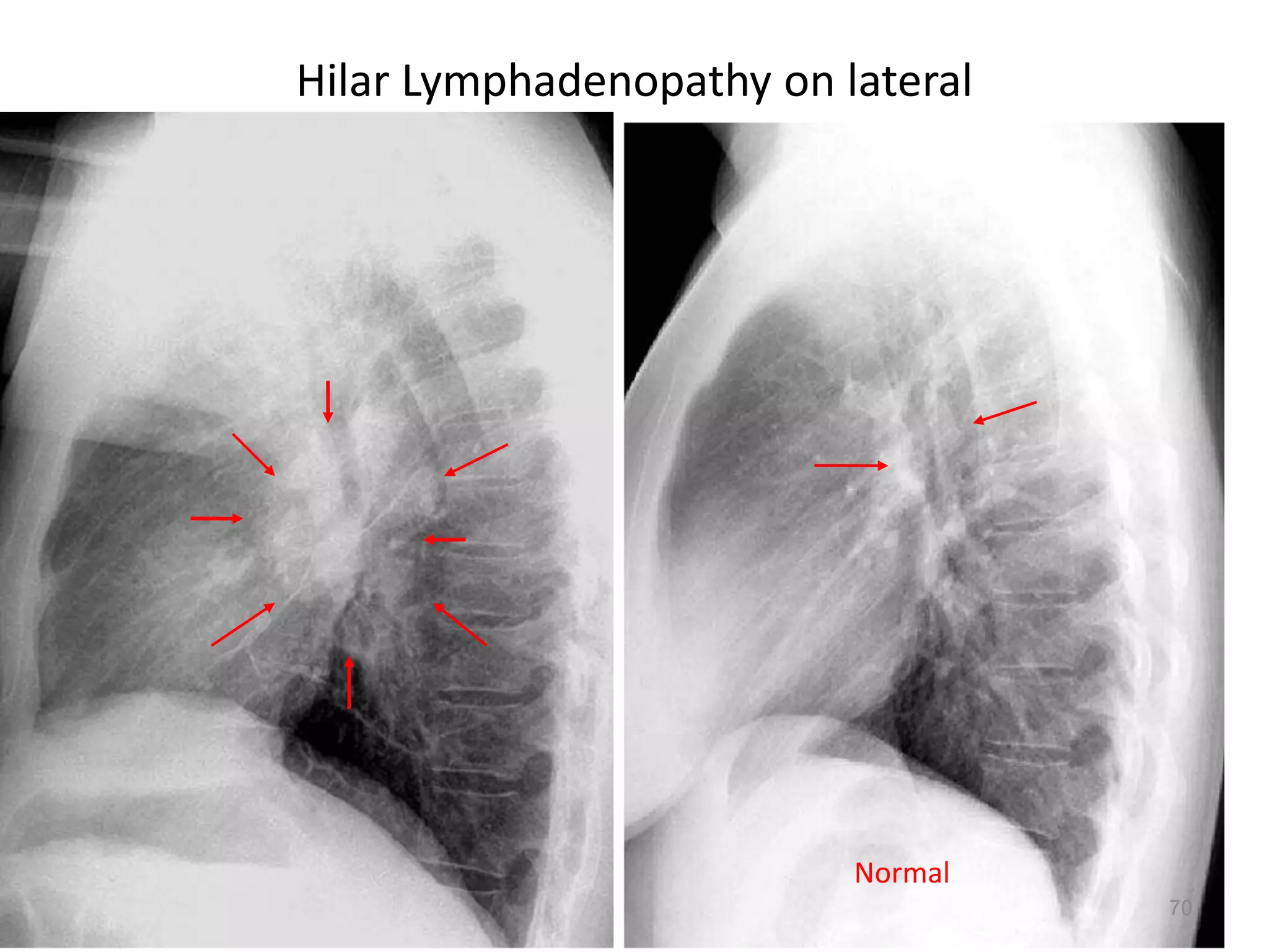 70154 slides
Hilar Lymphadenopathy on lateral
70
Normal
 