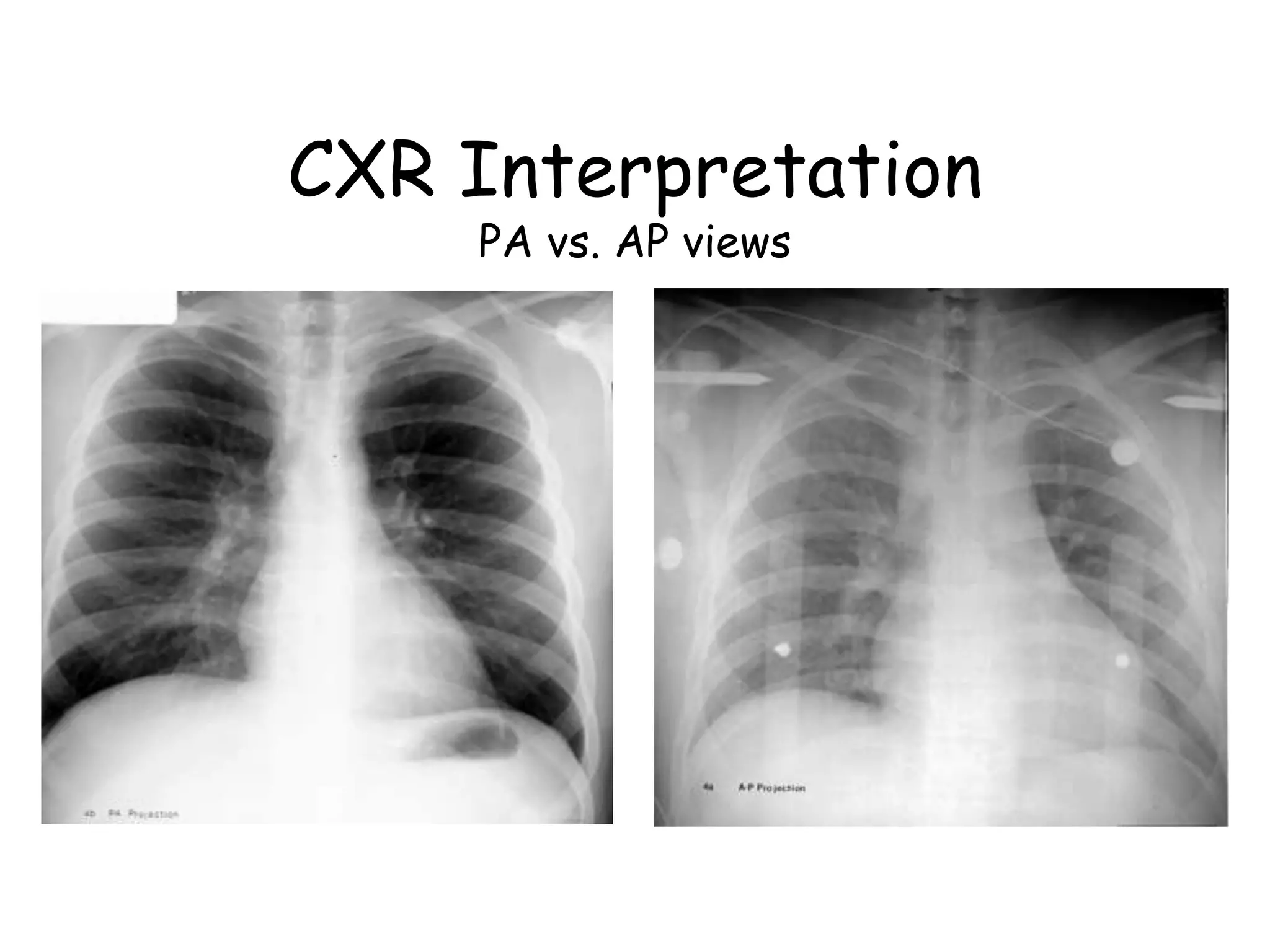 CXR Interpretation
PA vs. AP views
 