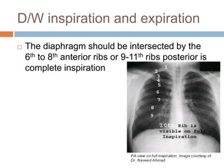 D/W inspiration and expiration
 The diaphragm should be intersected by the
6th to 8th anterior ribs or 9-11th ribs posterior is
complete inspiration
 