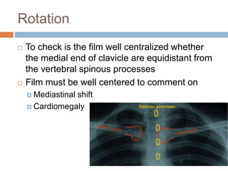 Rotation
 To check is the film well centralized whether
the medial end of clavicle are equidistant from
the vertebral spinous processes
 Film must be well centered to comment on
 Mediastinal shift
 Cardiomegaly
 