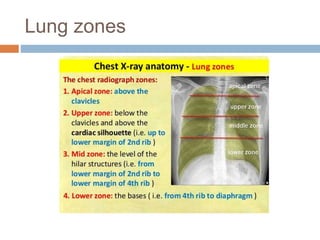 Lung zones
 