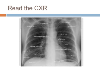 Read the CXR
 