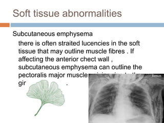 Soft tissue abnormalities
Subcutaneous emphysema
there is often straited lucencies in the soft
tissue that may outline muscle fibres . If
affecting the anterior chect wall ,
subcutaneous emphysema can outline the
pectoralis major muscle , giving rise to the
ginkgo leaf sign .
 