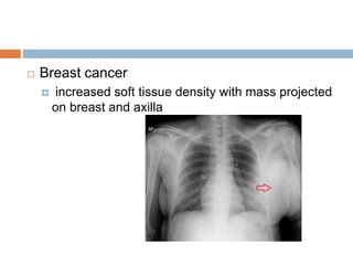  Breast cancer
 increased soft tissue density with mass projected
on breast and axilla
 
